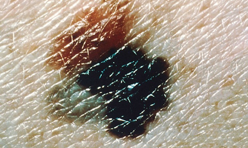 Taxa de mortalidade por melanoma aumentou em homens, diz estudo