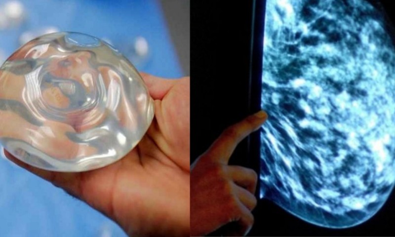 Forma rara de câncer é encontrado em 660 mulheres devido aos implantes de mama