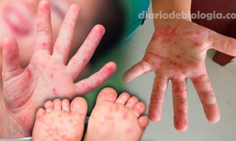 Síndrome mão pé boca está se espalhando em creches e escolas