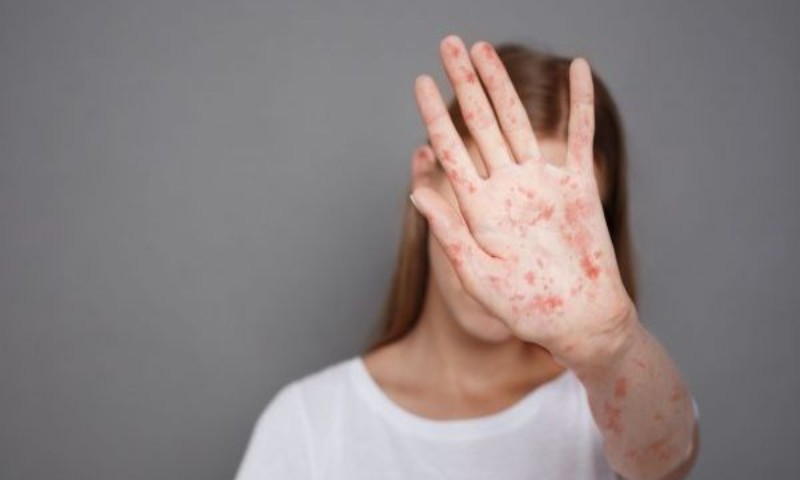 Sarampo: sintomas, prevenção, causas, complicações e tratamento