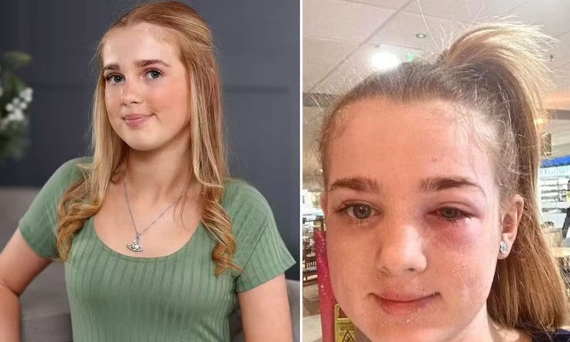 MUNDO: Adolescente quase fica cega após seguir dicas de beleza do TikTok