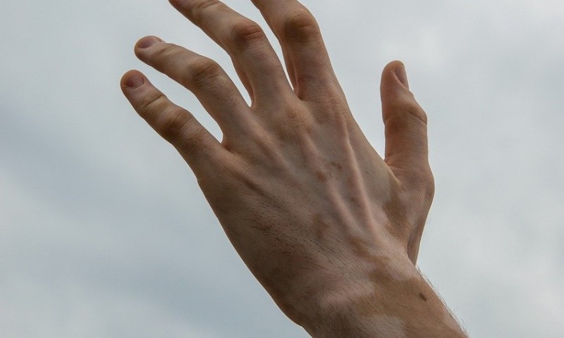 Vitiligo: doença não tem cura, mas opções de tratamento podem impedir sua evolução
