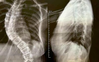 HSVP estreia mesa cirúrgica de última geração em procedimento de Escoliose via SUS