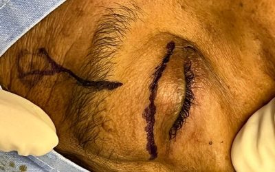 Cirurgia inédita no Brasil pelo SUS recupera visão de paciente